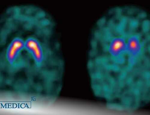 La malattia di Parkinson e il Datscan